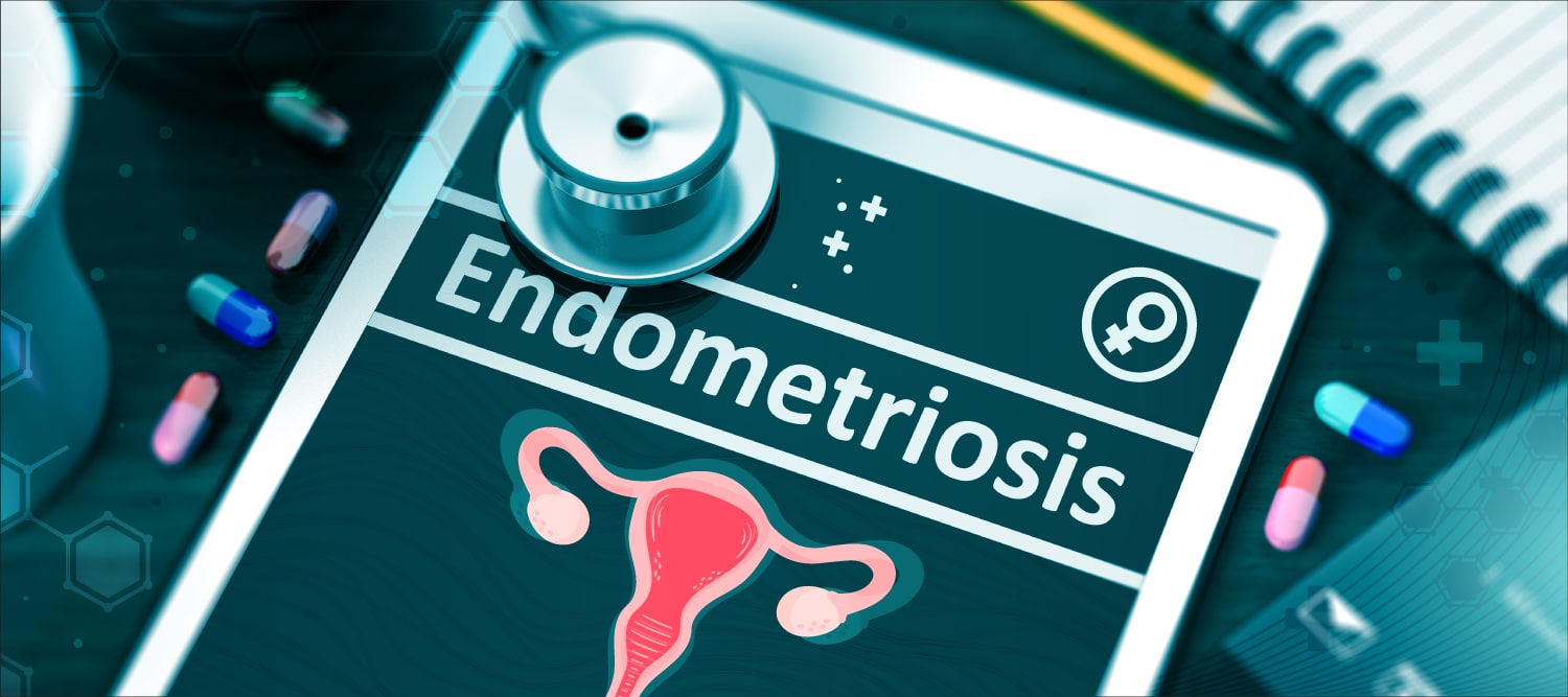 How healthcare professionals and key opinion leaders discuss endometriosis